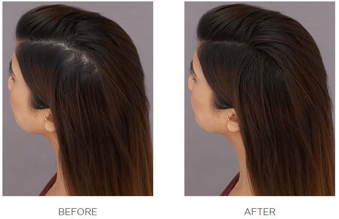 Cowlick Hairstyles Female
 before after charity Toppik Blog