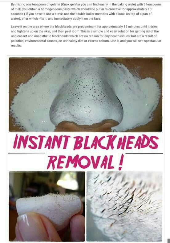 DIY Blackhead Remover Mask
 Blackhead removal Home Body