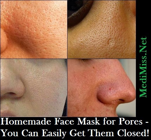 DIY Face Masks For Pores
 cicatrice bebe visage wiki