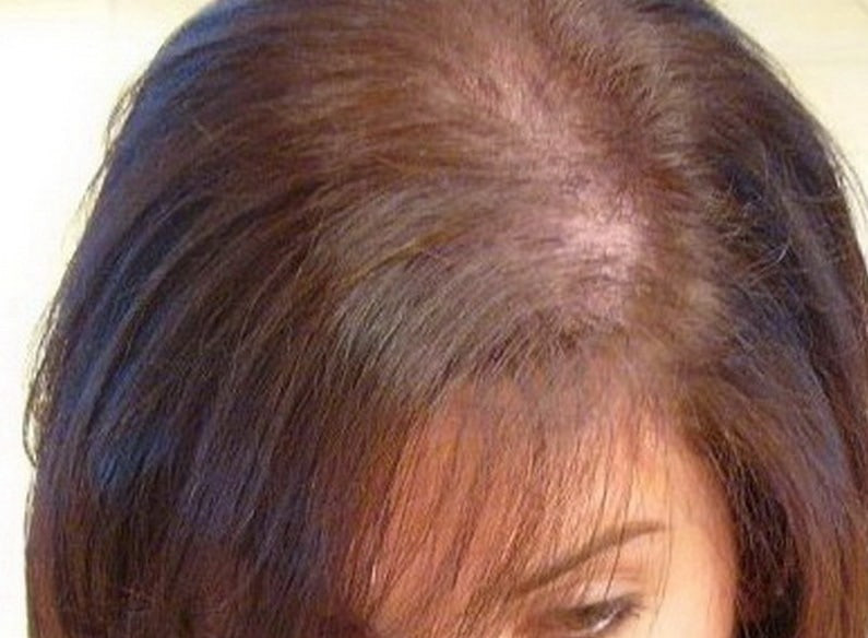 Hairstyles Female Pattern Baldness
 Prevent Baldness With A Little Care Indian Beauty Tips