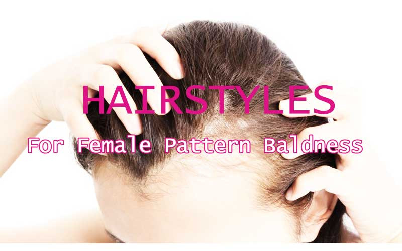 Hairstyles Female Pattern Baldness
 Female Pattern Baldness Symptoms Causes Natural Remedy