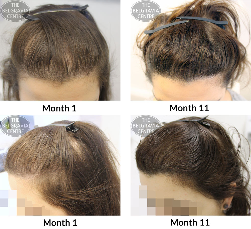 Hairstyles Female Pattern Baldness
 Hair Growth Success “I’m really grateful to all the team…”