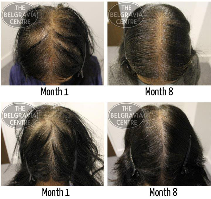 Hairstyles Female Pattern Baldness
 Hairstyles female pattern baldness