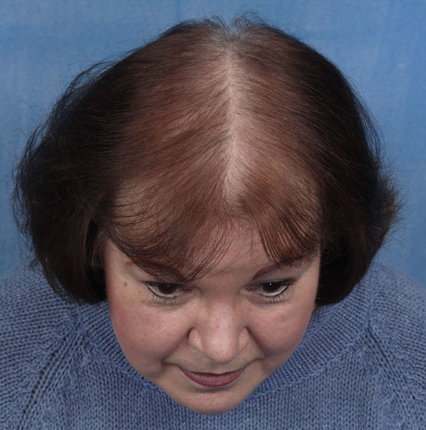 Hairstyles Female Pattern Baldness
 what cause hair loss All About hair loss