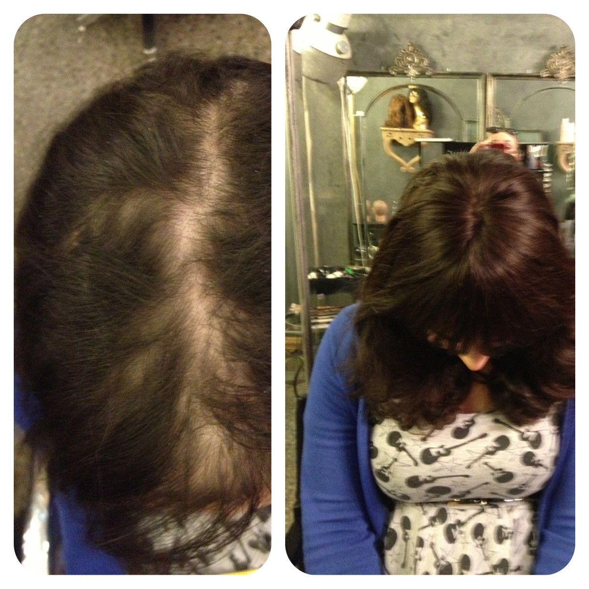Hairstyles Female Pattern Baldness
 Female Pattern Baldness Female Hair Loss Treatment Melbourne