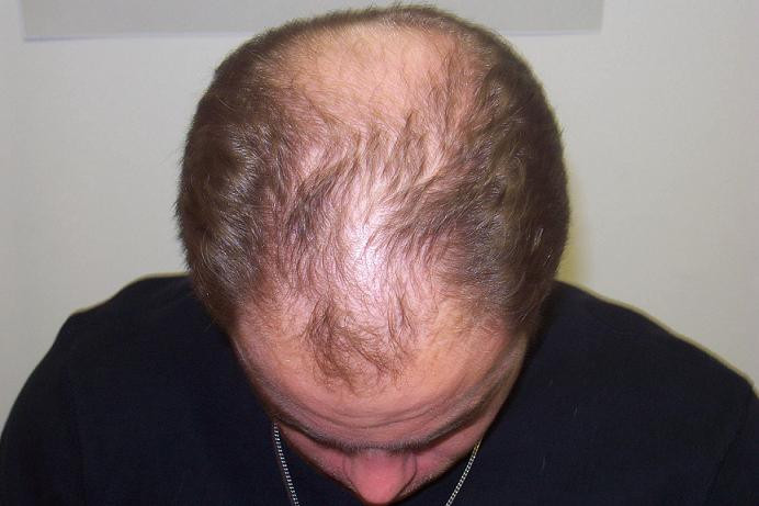 Hairstyles Female Pattern Baldness
 Hair Transplant & Hair Loss Interview with an Expert The