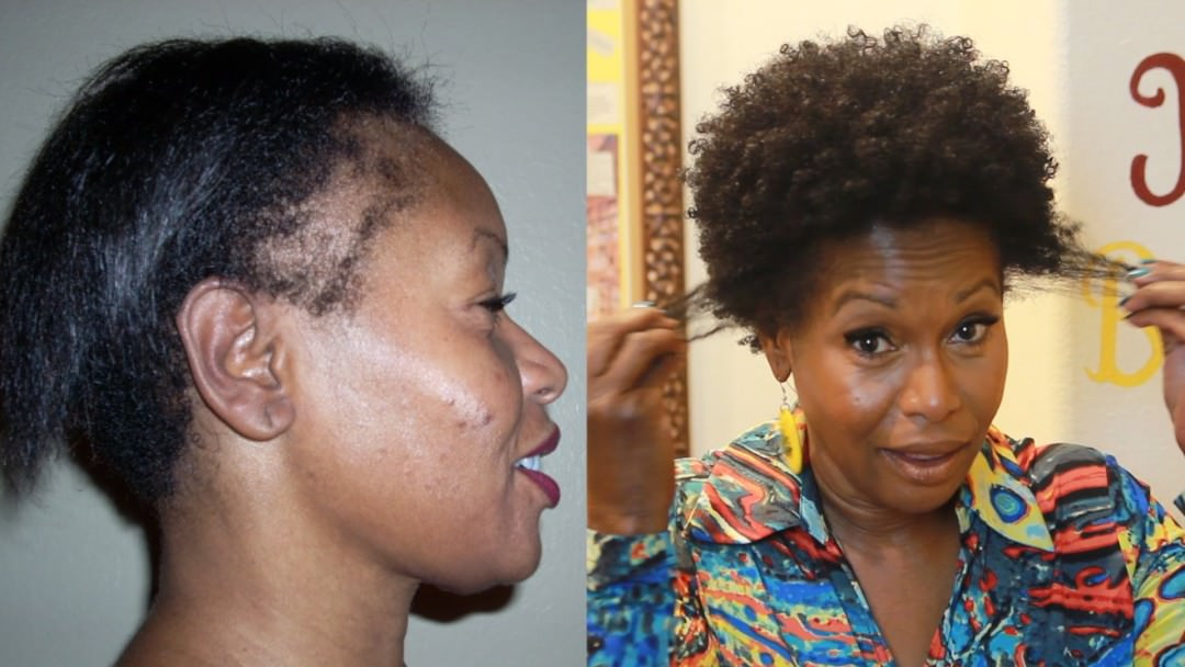 Natural Hairstyles For Thin Edges
 How I Repaired My Thinning Edges 2 Products [Video