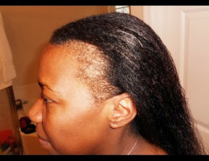 Natural Hairstyles For Thin Edges
 5 Natural Ways To Restore Thinning Edges