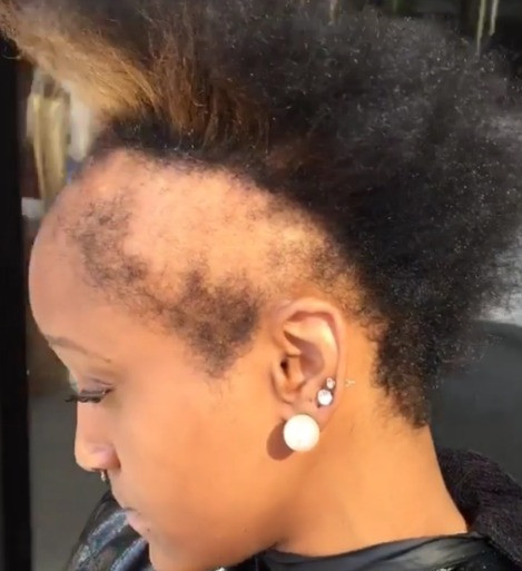 Natural Hairstyles For Thin Edges
 Woman Wears Sew Ins Nonstop For Years Loses Lots Hair